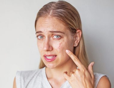 Too Much of a Good Thing: How Vitamin B12 Triggers Acne Breakouts