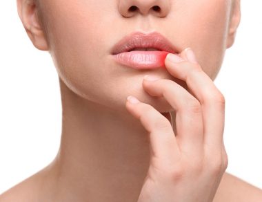 7 Natural Cold Sore Remedies